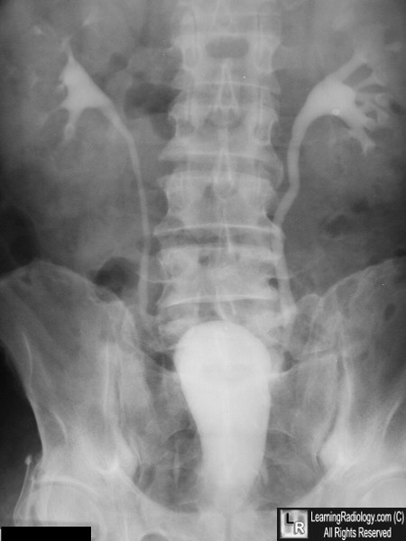 Pear-shaped urinary bladder